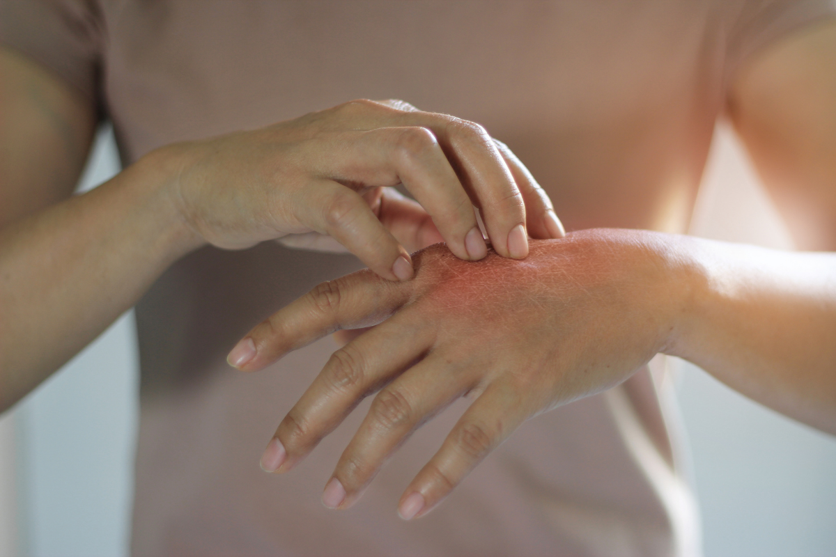 Łuszczyca skóry – jak ją leczyć?